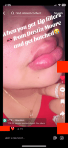 TikTok screenshot of someone's very swollen mouth with the words "When you get lip fillers from Dustin Moore and get botched"
